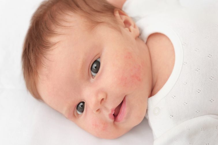 atopjiski dermatitis kod beba